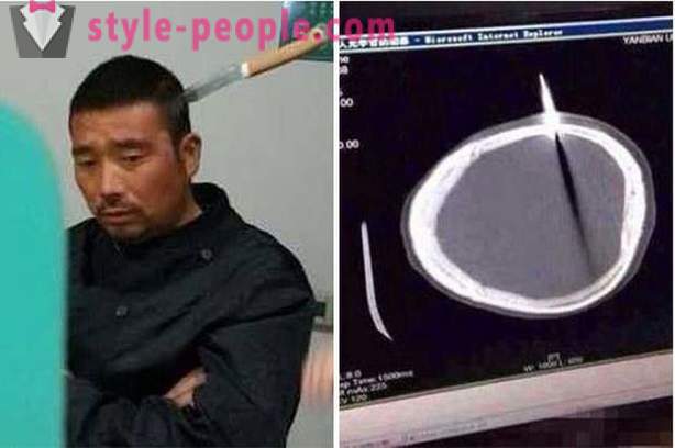 Ένας Κινέζος με ένα μαχαίρι στο κεφάλι του, πήγε στο γιατρό