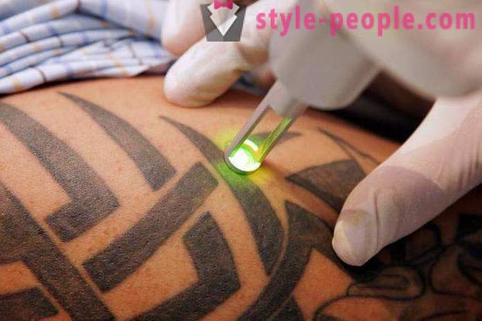 Αφαίρεση τατουάζ με λέιζερ. η κριτική έγινε η