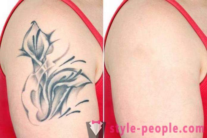 Αφαίρεση τατουάζ με λέιζερ. η κριτική έγινε η