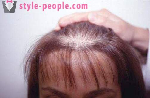 Darsonval μαλλιά. Αίτηση darsonvalya για τη θεραπεία και την πρόληψη της τριχόπτωσης