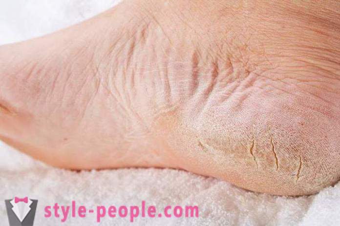 Ξηρό δέρμα στα πόδια σας: Αιτίες